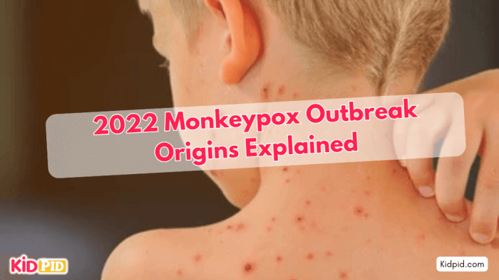 What Caused Monkeypox? Origins of 2022 Outbreak Explained
